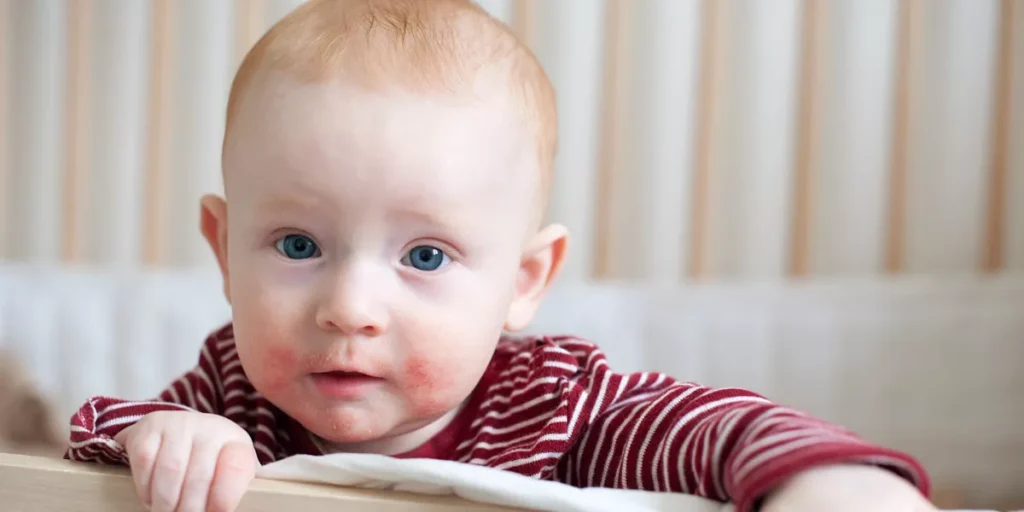 Managing-Allergies-in-Babies-1024x512.webp.webp